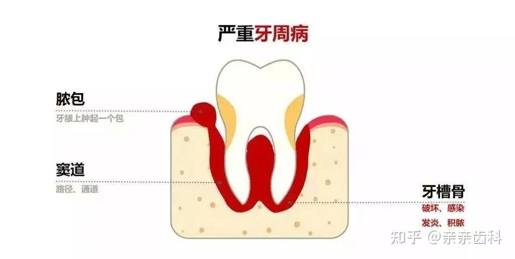 處理方法:將牙周袋或牙齦切開引流,緩解疼痛,沖洗膿腔導入消炎藥.