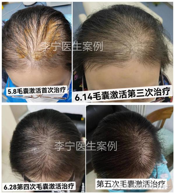 毛囊干细胞生发技术再次突破,秃头有救了! - 知乎