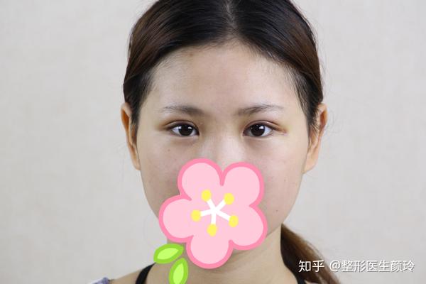 吊眼单眼皮不同程度的吊眼需要不一样的处理1