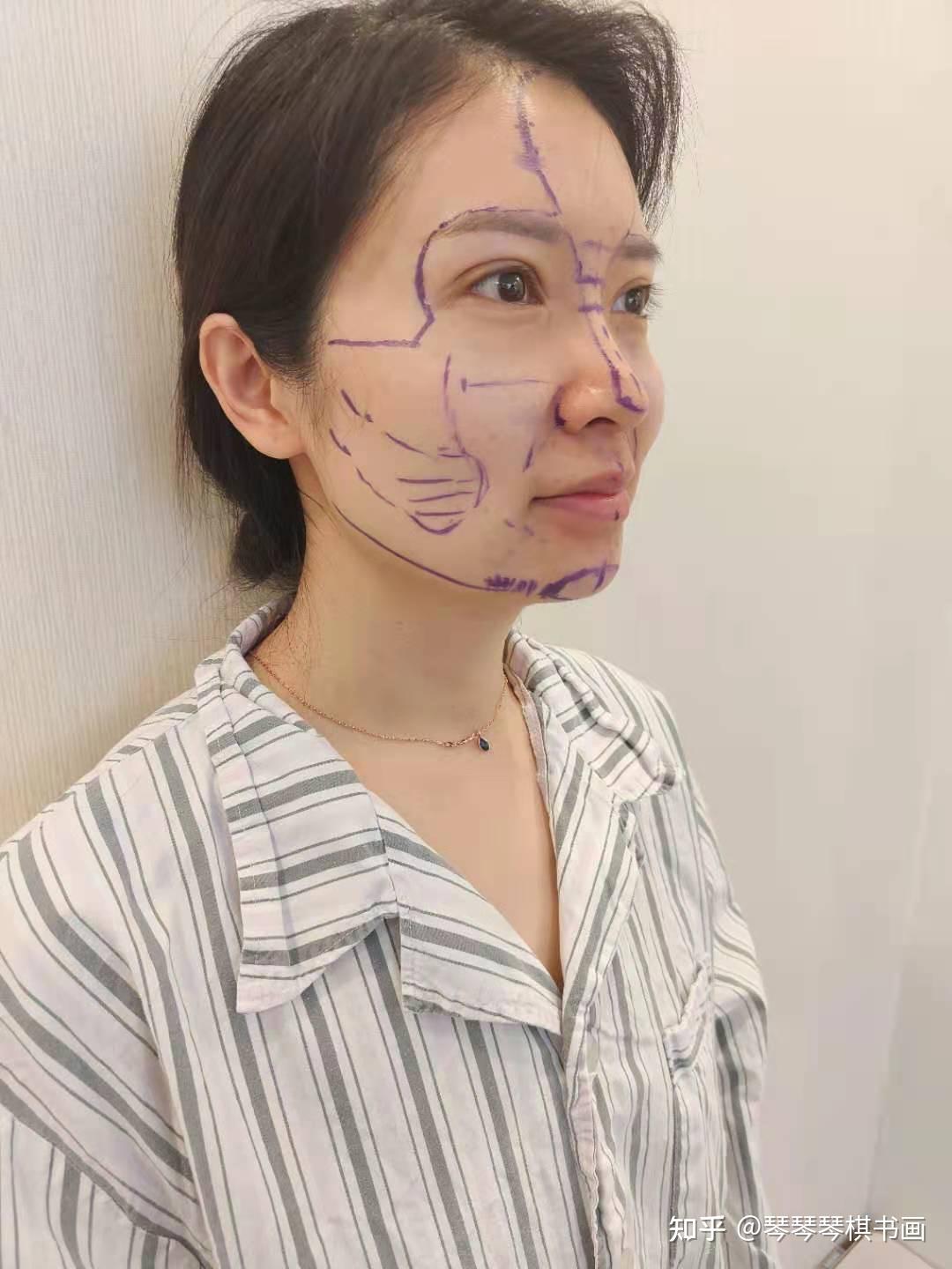 svf自体脂肪干细胞胶填充全脸手术过程记录