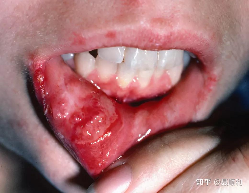 反复口腔溃疡是怎么回事