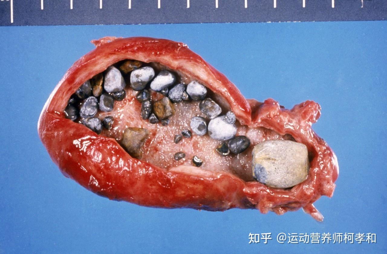 胆管结石图片清晰图片图片