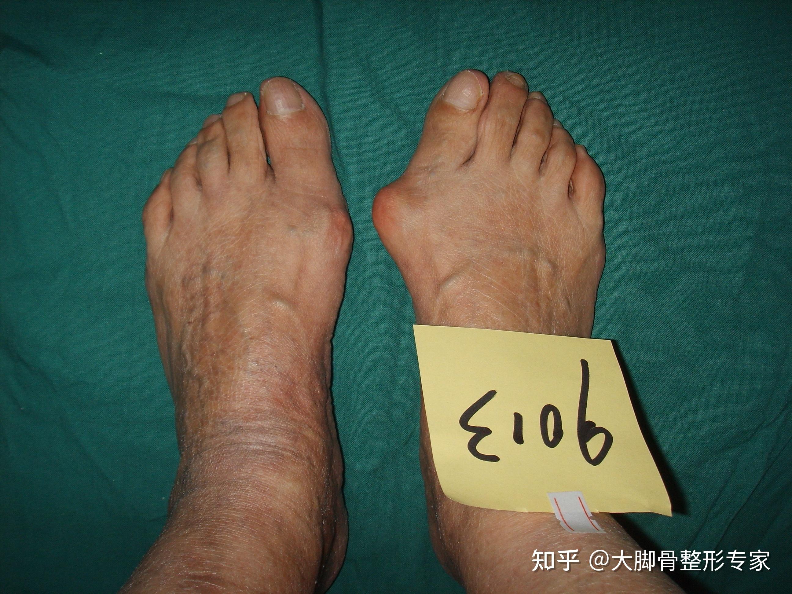 因为这个大脚骨手术前后对比太强烈很多人认为不是同一个人的脚大家