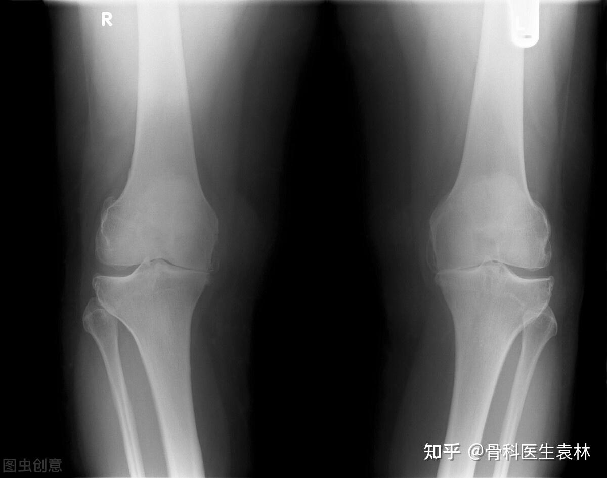 交叉韧带解剖及损伤的MRI诊断_膝关节