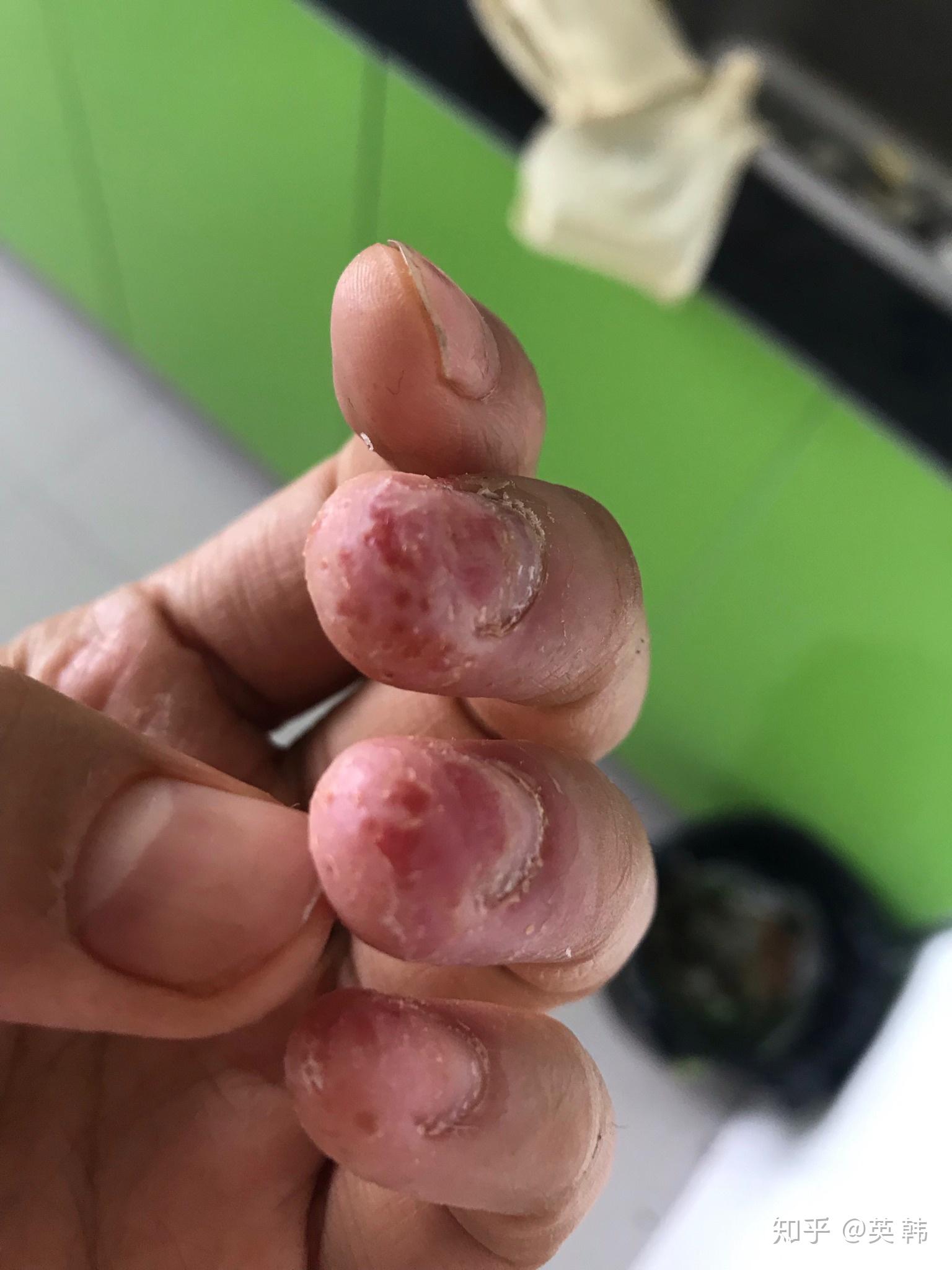 汗疱疹真菌感染还是掌拓脓疱病