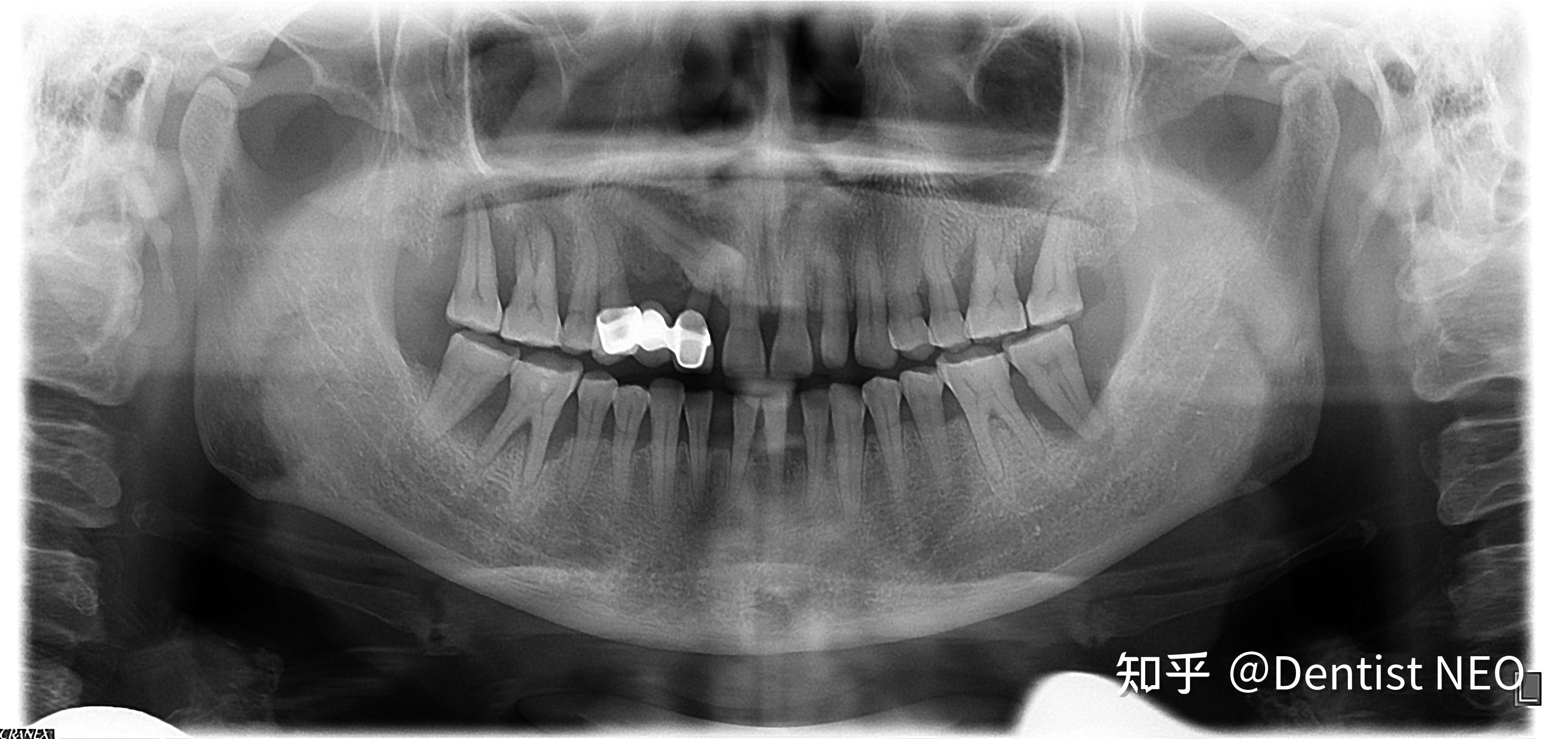 牙齿矫正+单颌手术，还你一张美丽侧颜！ - 贝致案例库 - 贝致——专业口腔服务平台，权威医生，真实案例，一次看够