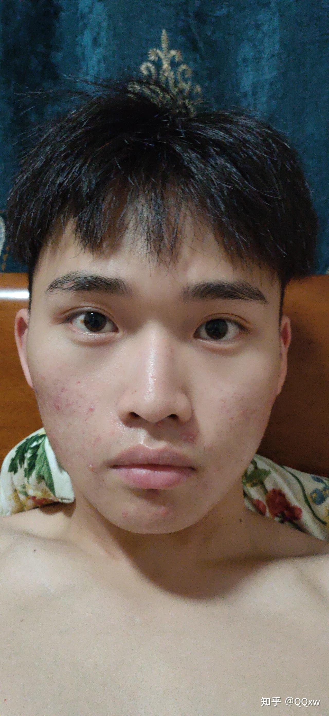 眼睛一高一低脸都极大不对称? - 知乎