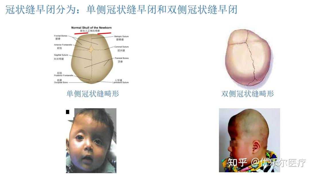 冠状缝早闭2,三角形状态:一种三角形的凸起状态,眼睛聚中,非骨融性的