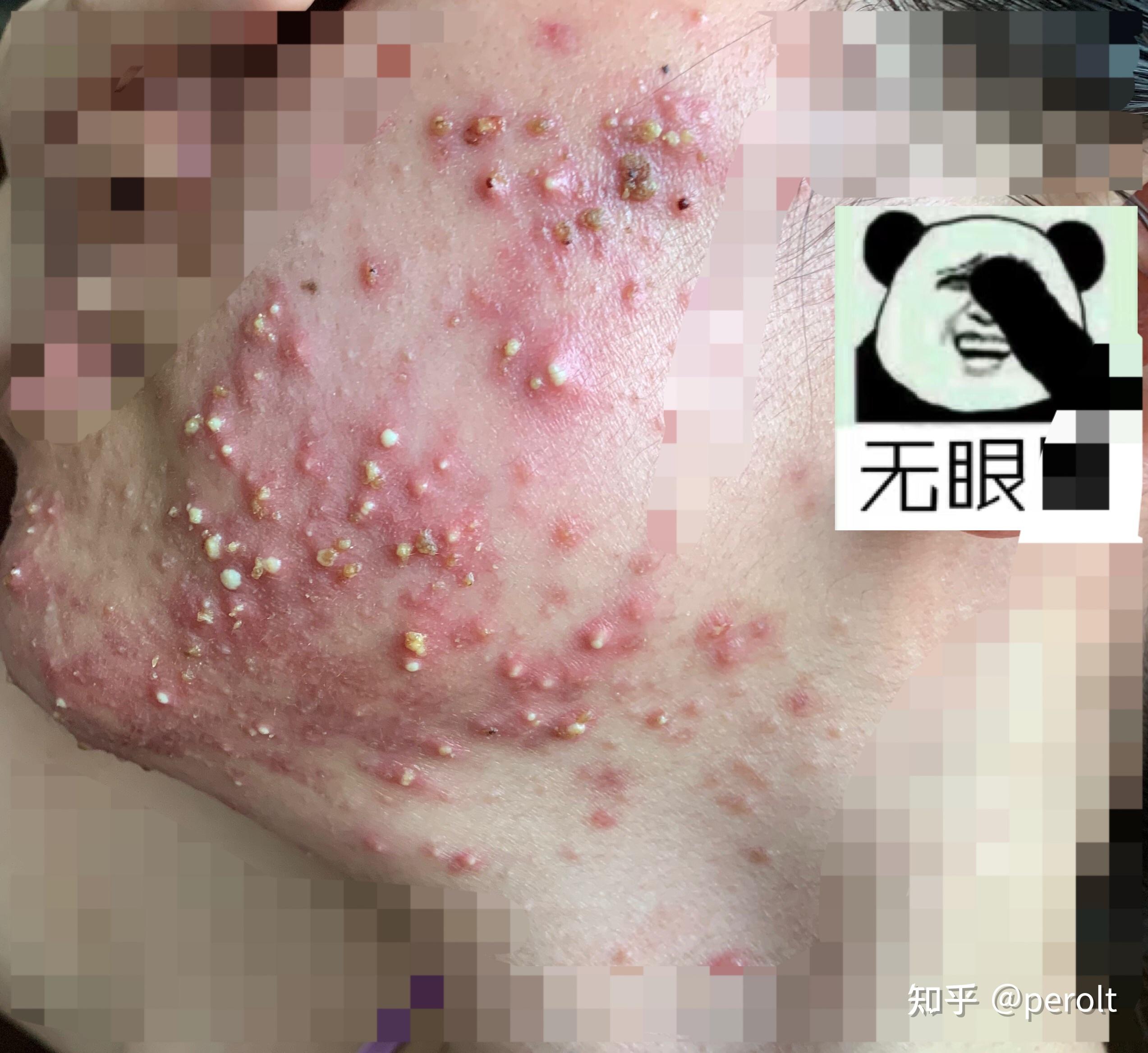 烂脸异维a治疗痤疮到痊愈记录