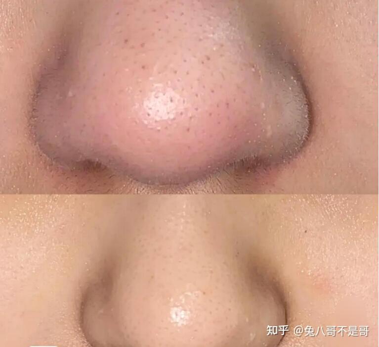 鼻子上有鸡皮疙瘩怎么办(鼻子上有鸡皮疙瘩怎么办啊) 鼻子上有鸡皮疙瘩怎么办(鼻子上有鸡皮疙瘩怎么办啊)