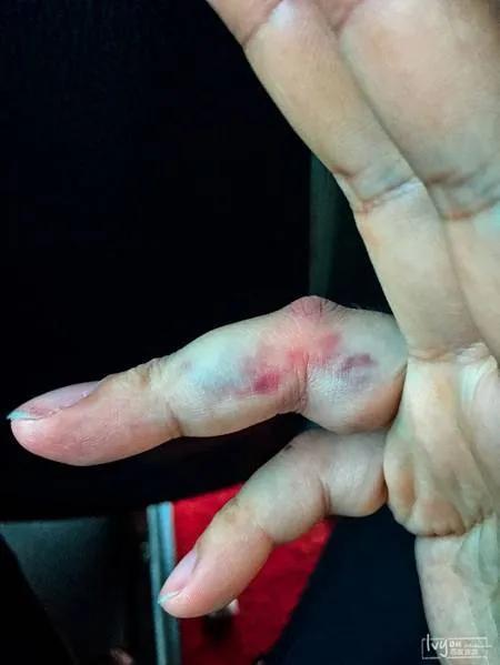 手指受伤的一天里主要是淤青,到了第二天开始手指就开始淤血散开,手指