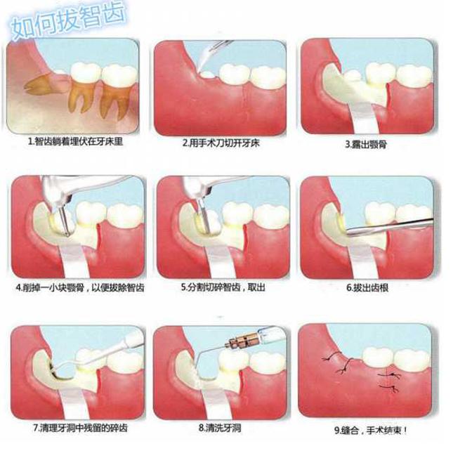 拔牙看起来是一个简单的牙科小手术但其实并不简单