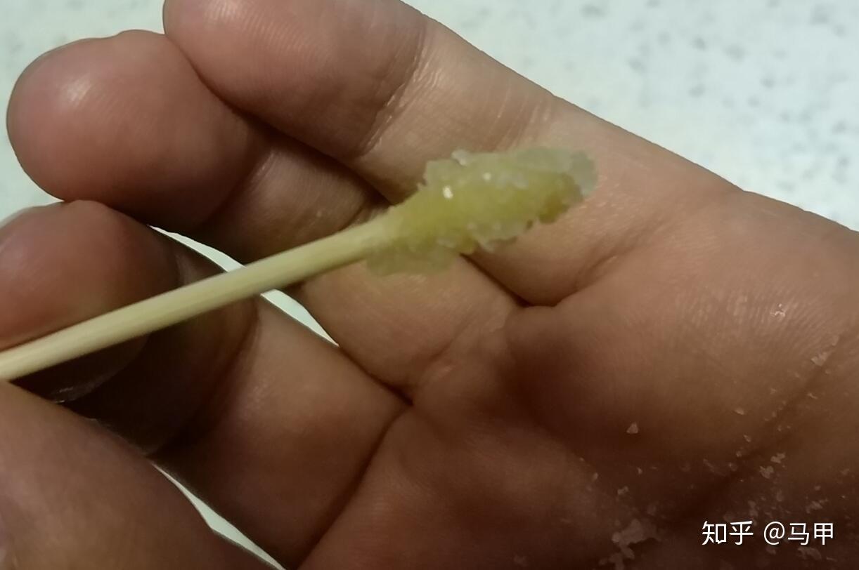 反复扁桃体发炎我是怎样治好的