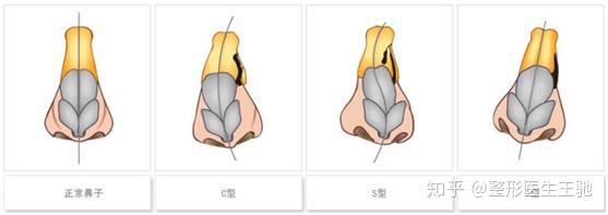 歪鼻子应该怎么办 知乎