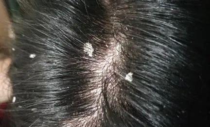 如何做好头皮护理预防头皮屑过多? - 知乎