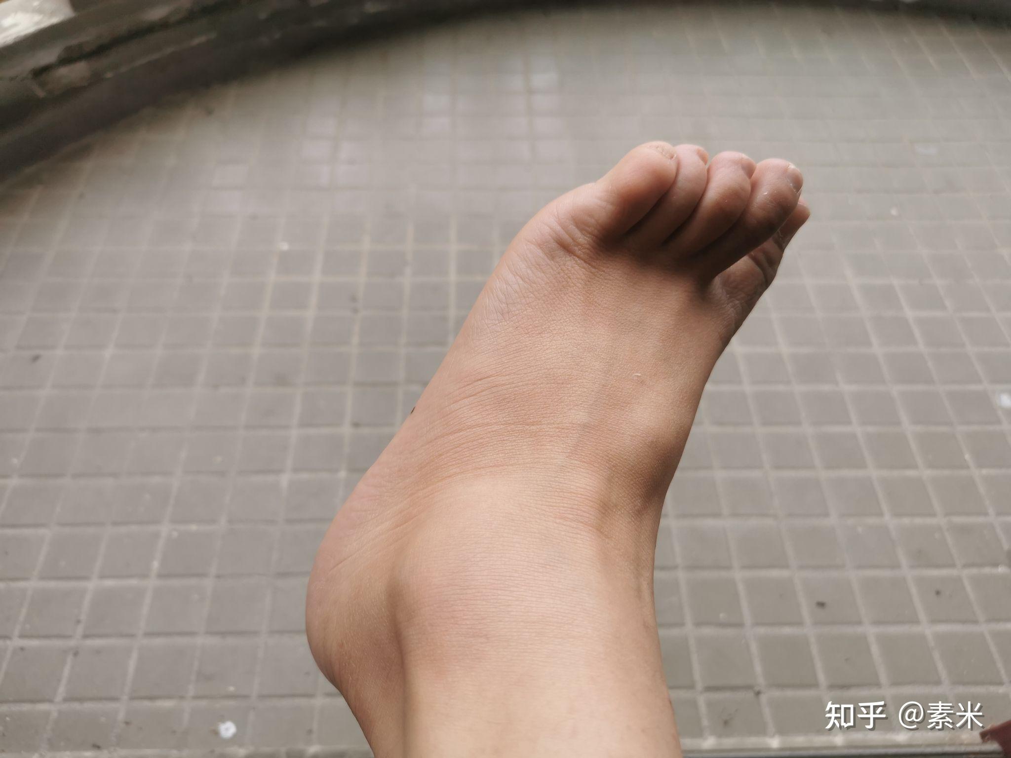 脚扭伤恢复记录