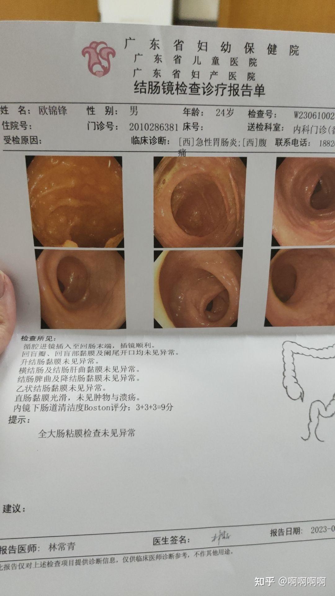 肠镜阑尾开口正常图片图片