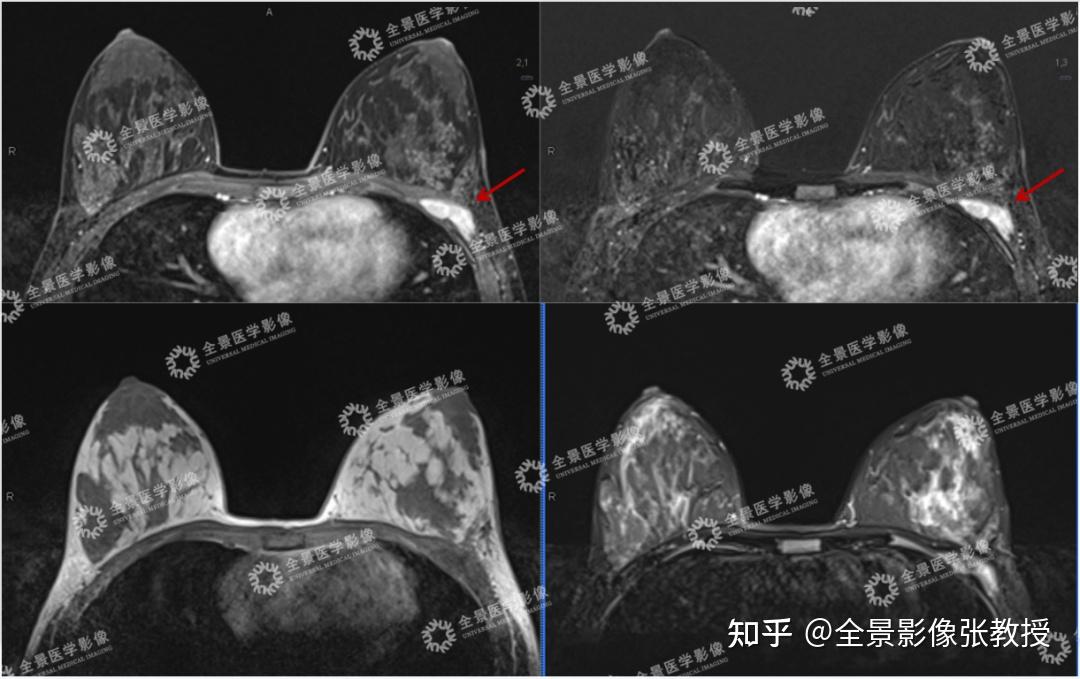 意外發現胸部硬塊是乳腺腫瘤還是另有貓膩