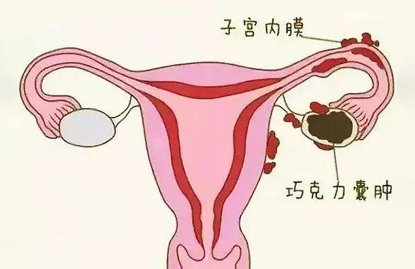 卵巢巧克力囊肿 症状图片