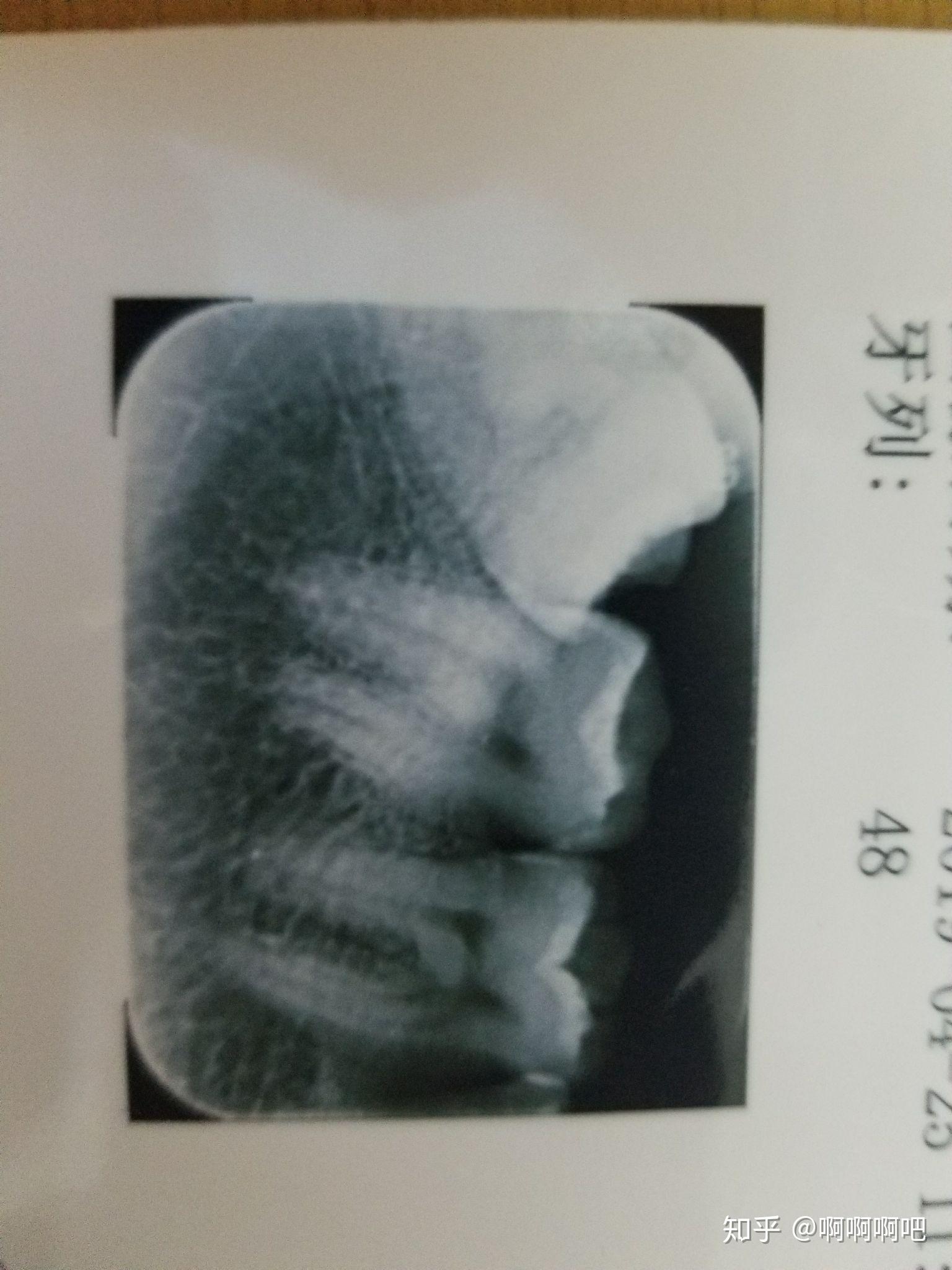 南京市口腔医院拔智齿价格?