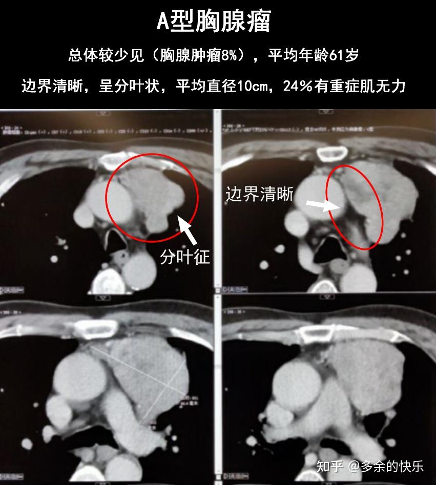 胸腺癌治疗那些事(十四)胸部CT看片入门 - 知乎