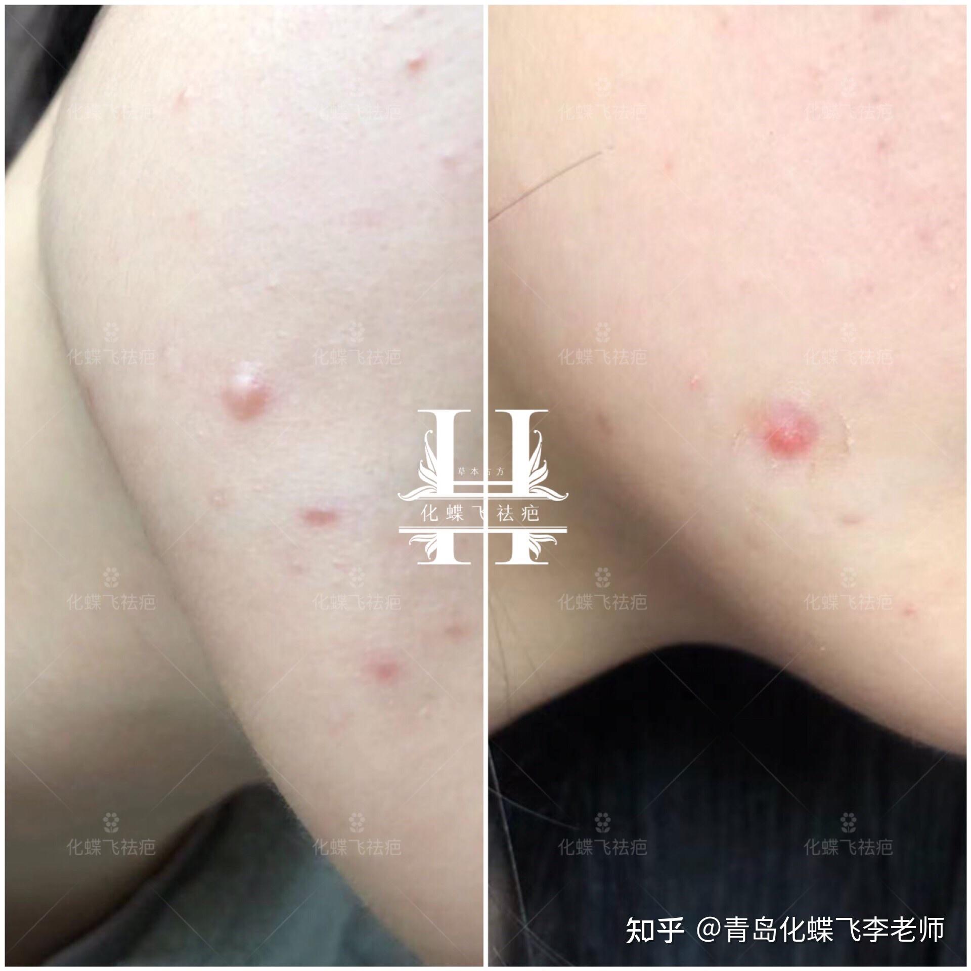 塗中藥#祛疤,結痂掉痂代謝一次,平復了很多,美女很開心 終於看到希望