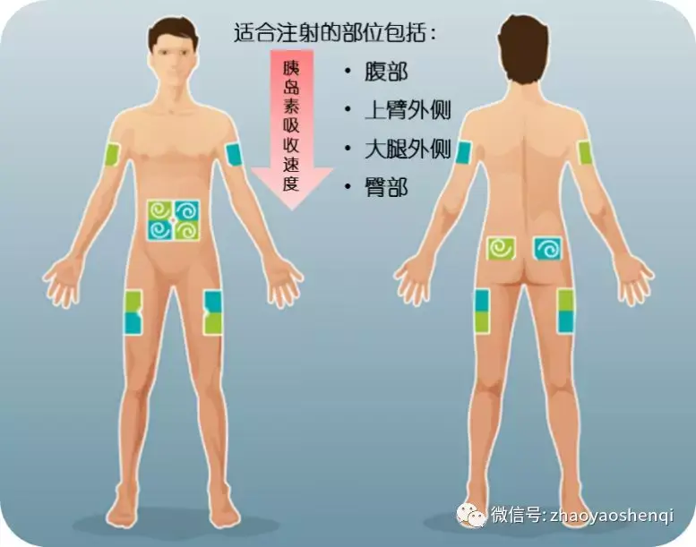 克赛注射部位图片