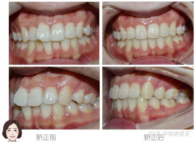 郑州牙齿前突不矫正会有危害吗