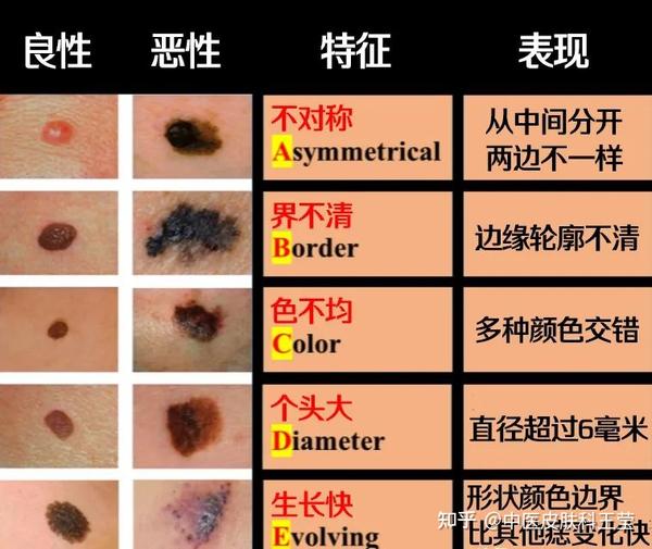 身上的痣，能点掉吗？医生：不能胡乱点！ - 知乎