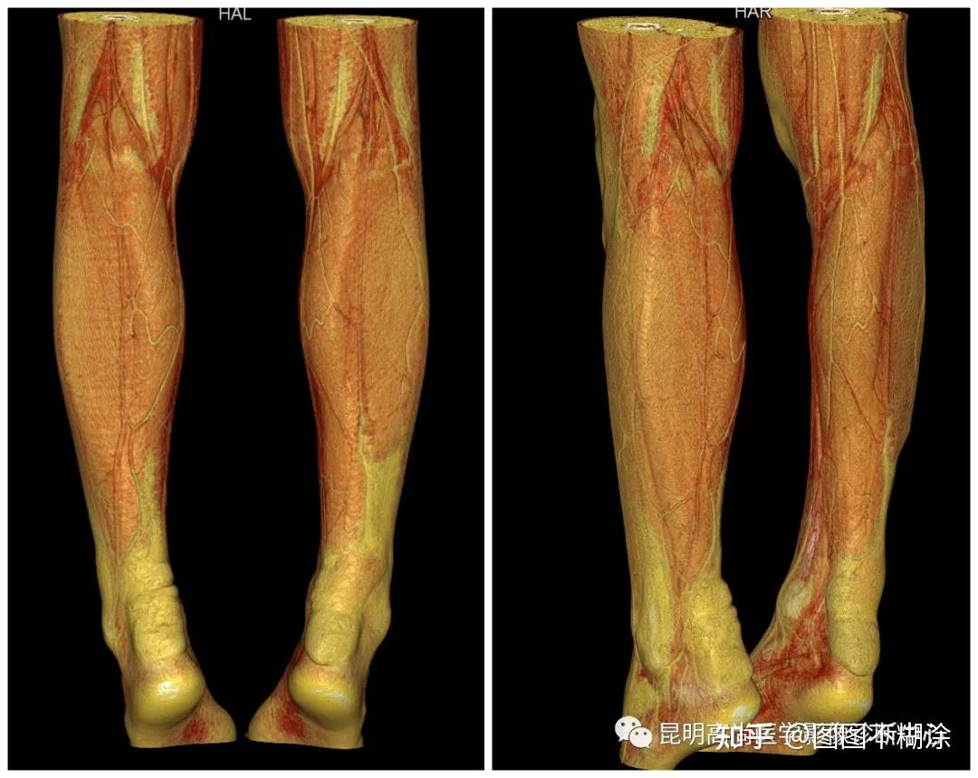 昆明高尚病例腱黄色瘤一例