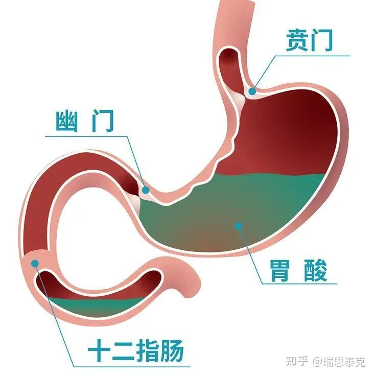 胃食管反流病，反流的到底是些什么？ - 知乎
