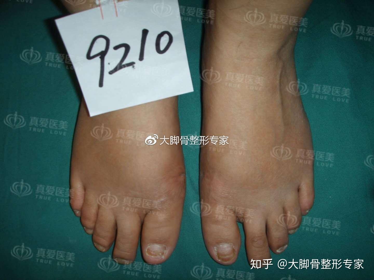 大脚骨拇指外翻的畸变原因及矫正方法