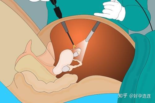 宫腔分离2mm图片