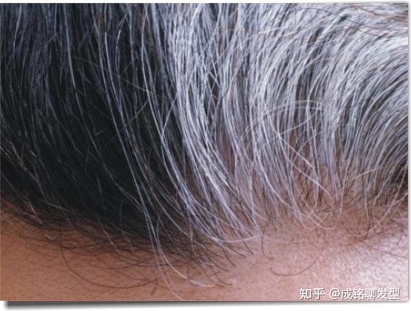 年纪轻轻就满头白发,显老又没气质,有什么方法可以减少长白发? - 知乎