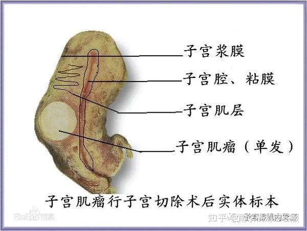 極多小瘤結節分佈全部子宮壁,呈不規則團塊狀融合,構成多發性子宮肌瘤