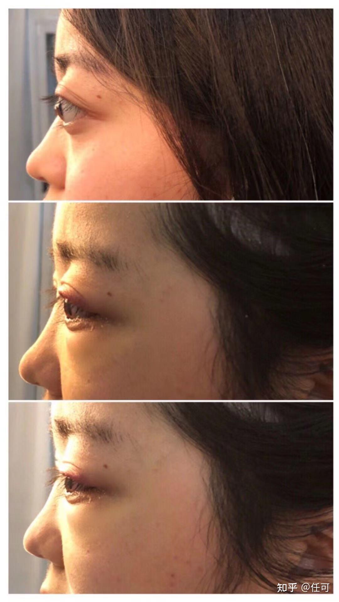 顶着金鱼眼过日子是一种怎么样的体验