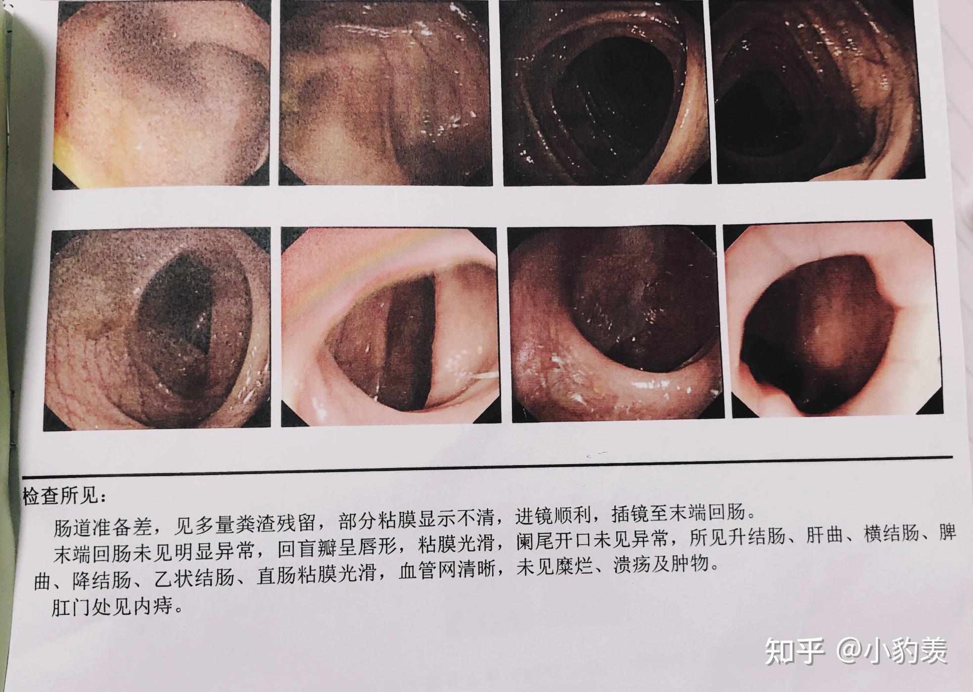 肠镜痛苦吗图片