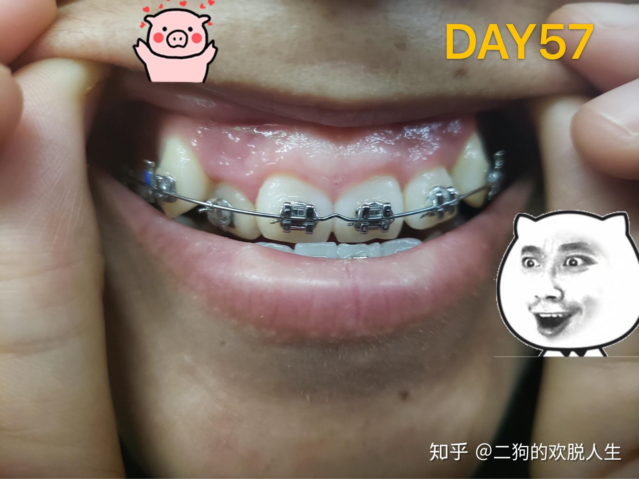 地包天尖牙上凸正畸拔牙过程记录