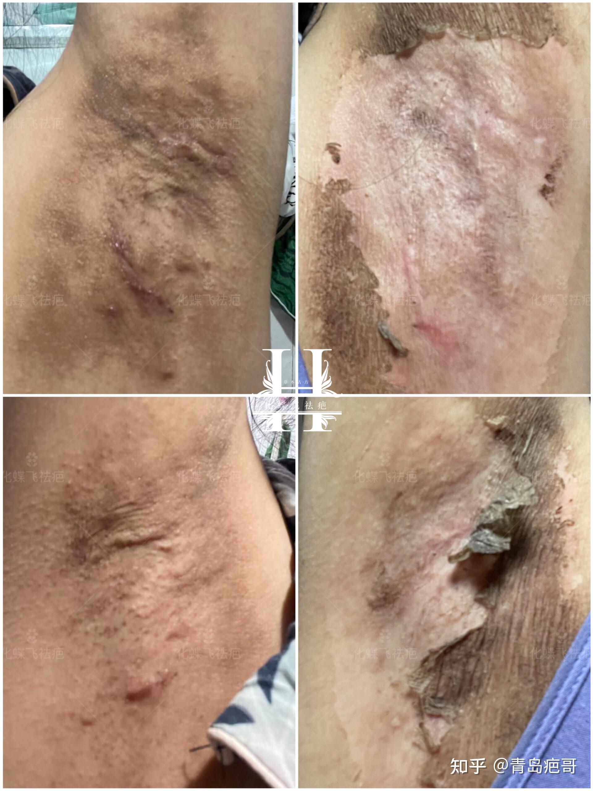 青海美女的腋下手术疤痕和色素沉着
