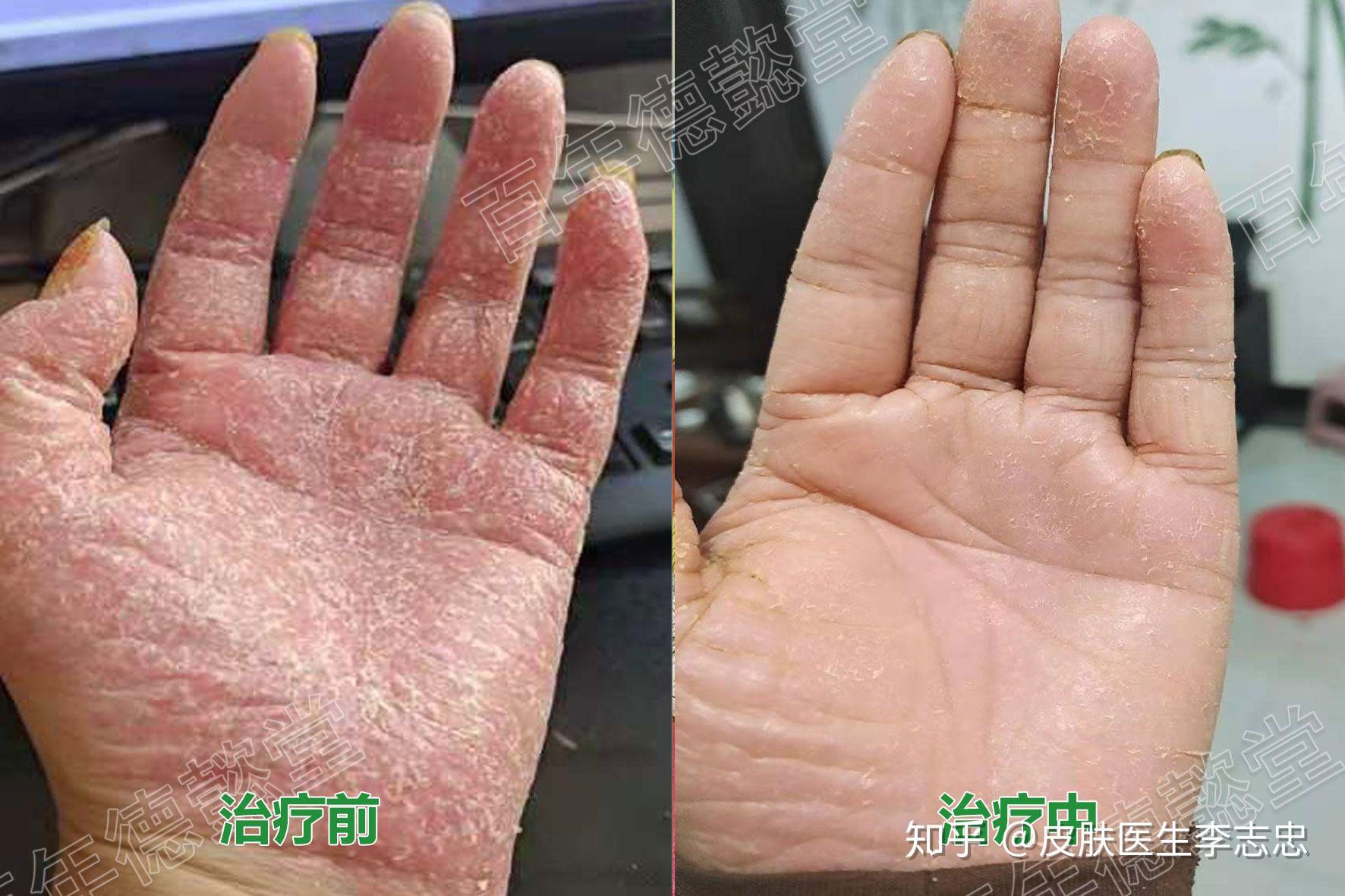 分享一例掌跖脓疱病治疗案例