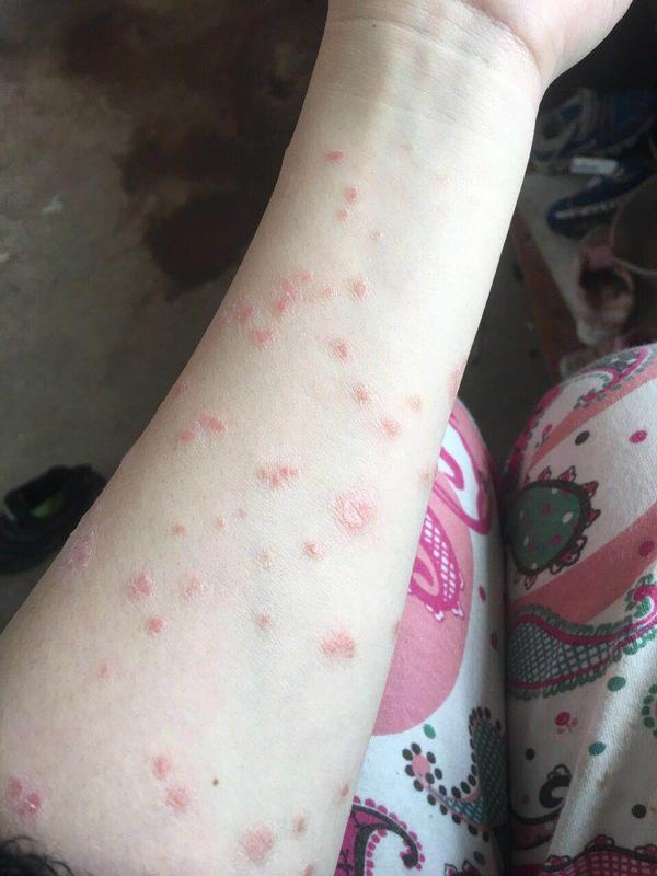 牛皮癣银屑病有什么好的治疗方法吗