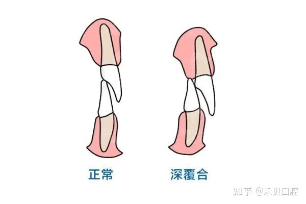 牙齿深覆合如何打开咬合？ 知乎