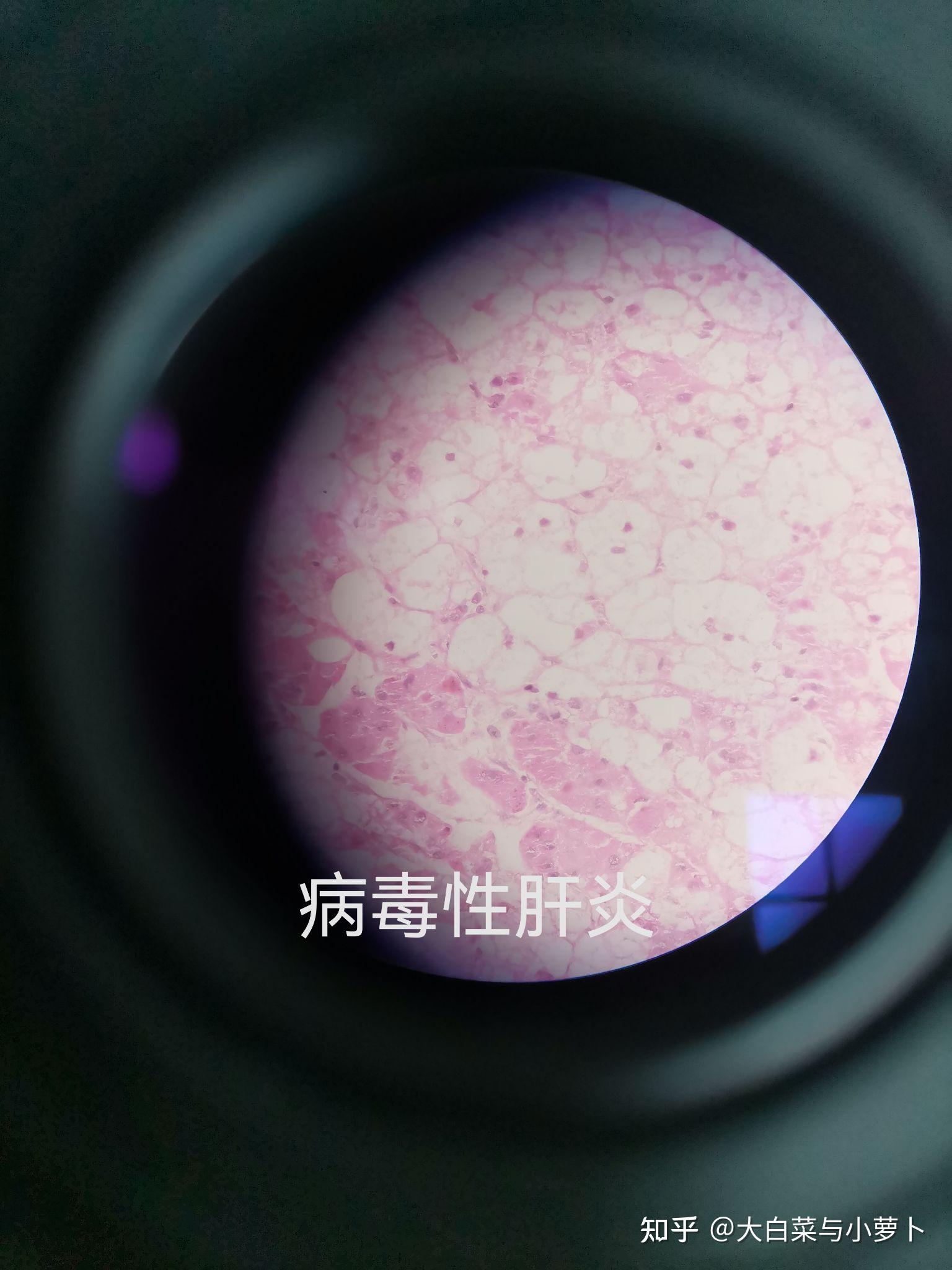 病毒性肝炎5.细胞核增大,集聚成群.4.肌丝呈波浪状.3.横纹肌结构消失.