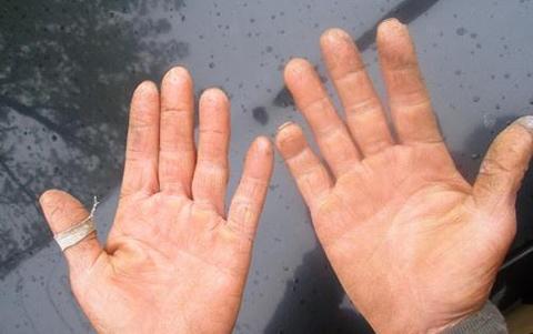 健康小知识肝癌来临前,"手脚"会有这4种表现,一个不占,值得恭喜赞同了