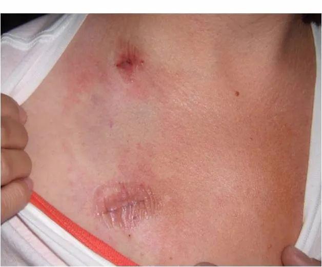 扎手,picc还是输液港?