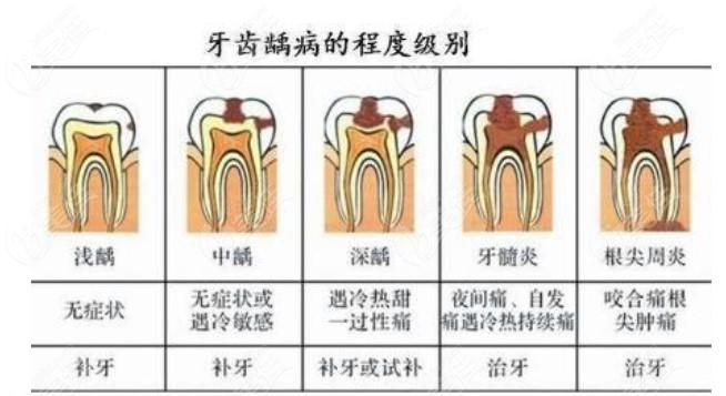 蛀牙疼痛难忍怎么办？口腔达人教你6个好方法 - 知乎