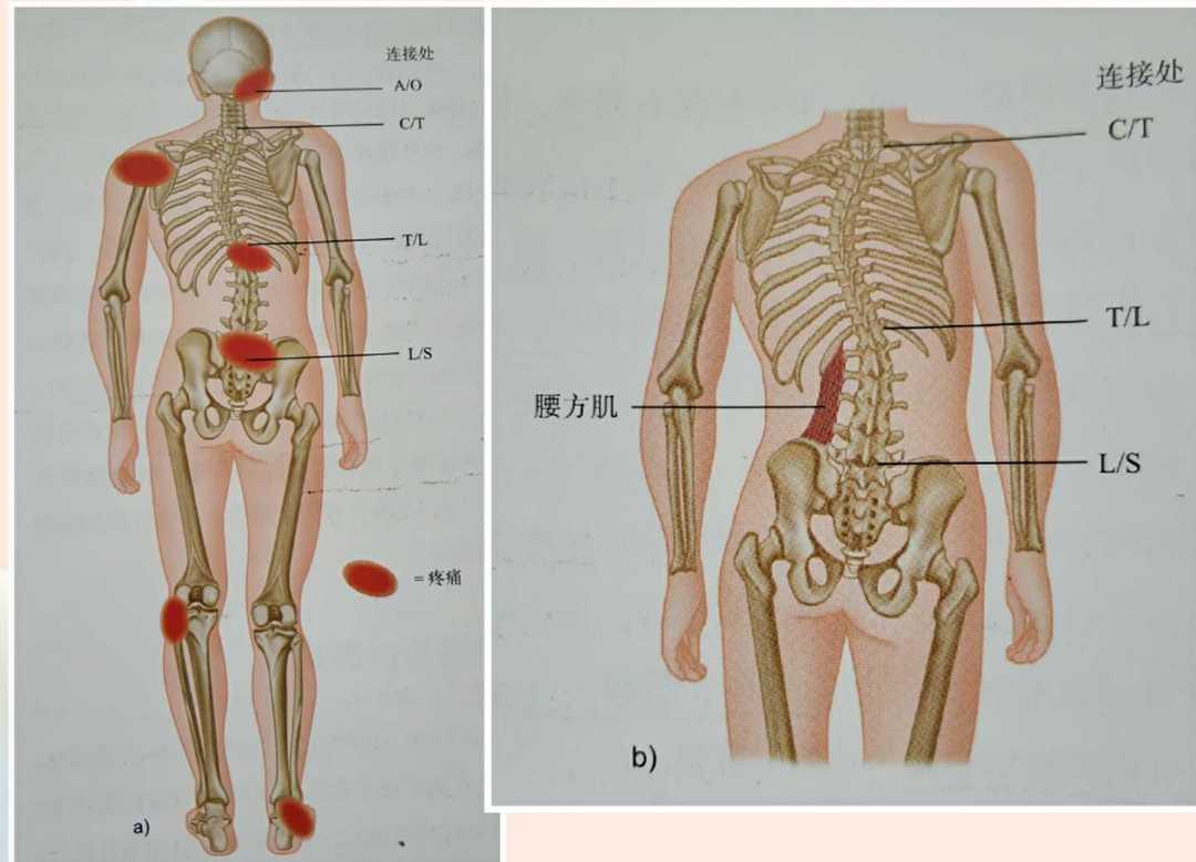 当肩峰,肩胛骨下角和骨盆不对称或倾斜,下肢不等长时,存在脊柱侧弯