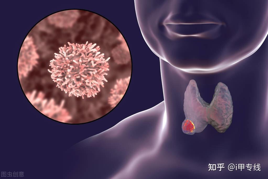 甲状腺滤泡状癌图片