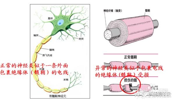 脫髓鞘多 見於病毒,炎症,缺氧, 中毒,外傷無菌炎性水腫侵犯了髓磷鞘