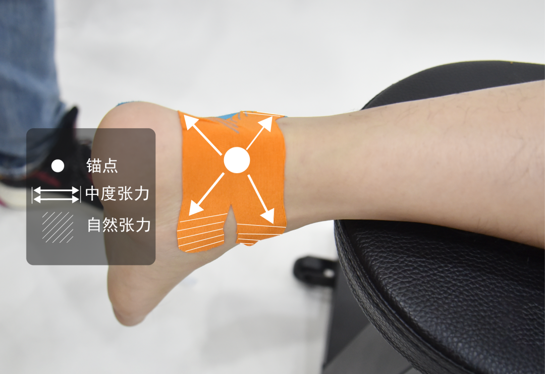 将肌效贴裁剪成x型,锚点贴在跟腱处,贴布施加中度张力向两侧贴去,最后